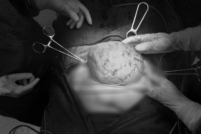 Hà Nội phẫu thuật thành công khối u xơ tử cung kích thước lớn cho nữ bệnh nhân 40 tuổi