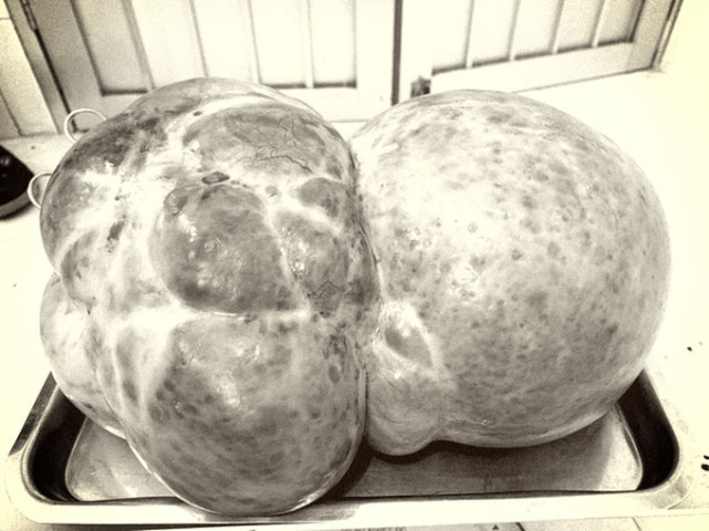 Hà Giang phẫu thuật khối u nang buồng trứng nặng hơn 7kg cho nữ bệnh nhân