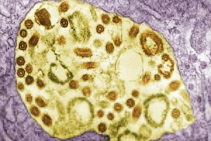 Lần đầu tiên phát hiện virus Marburg lây nhiễm và gây chết người ở Ghana