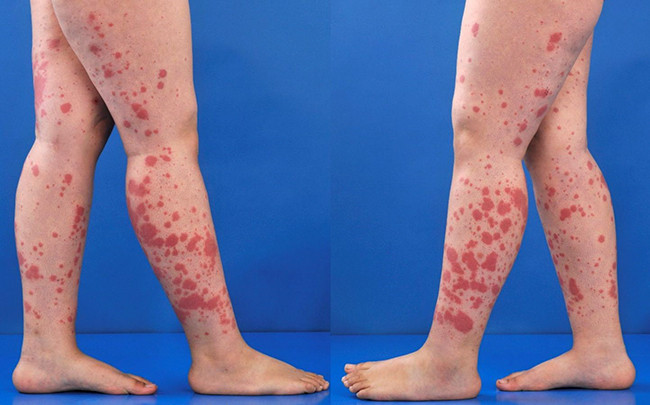 Viêm mao mạch dị ứng ở trẻ em có thể gây biến chứng nghiêm trọng