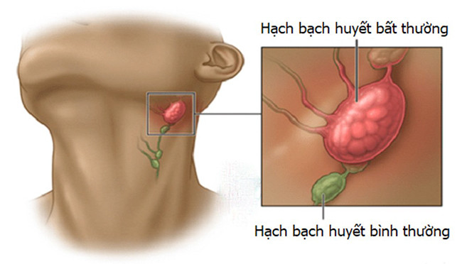 Cách nhận biết sưng hạch ở trẻ em