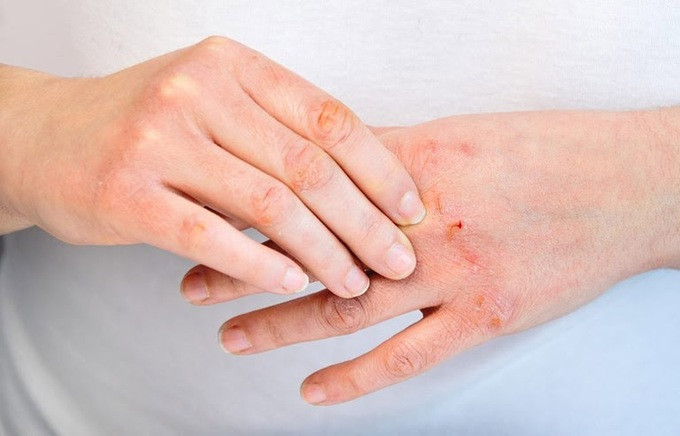 Mẹo đơn giản chữa viêm da do thời tiết