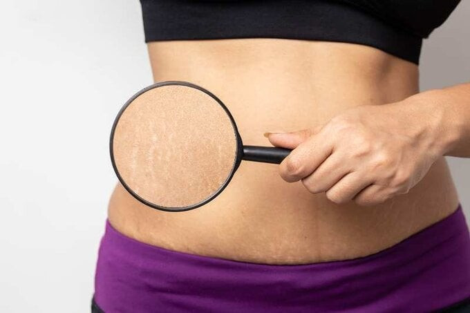 Cách làm kem trị rạn da với các nguyên liệu tự nhiên