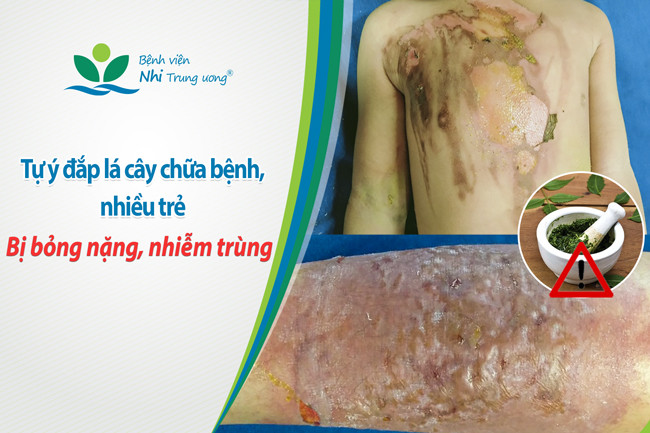 Chuyên gia cảnh báo hậu hoạ khôn lường từ đắp lá cây, thuốc nam chữa bệnh