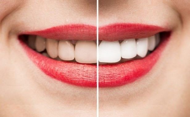 Quan niệm sai lầm về lấy cao răng