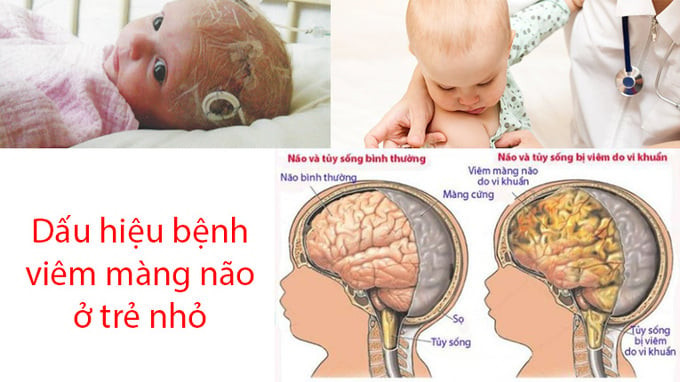 Cảnh báo di chứng lâu dài do viêm màng nào ở trẻ em