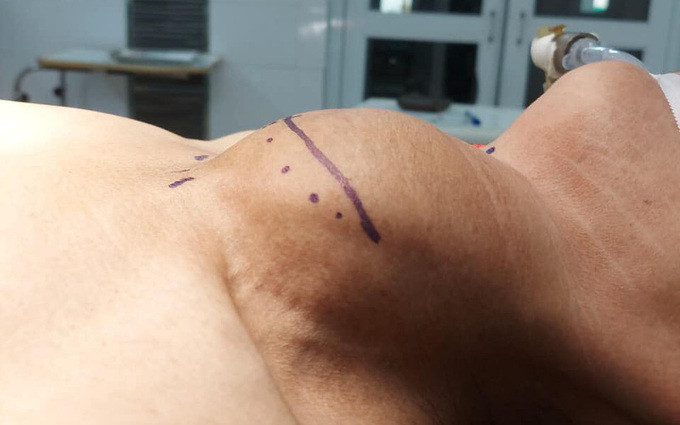 Tuyên Quang phẫu thuật bướu giáp chiếm toàn bộ vùng cổ bệnh nhân