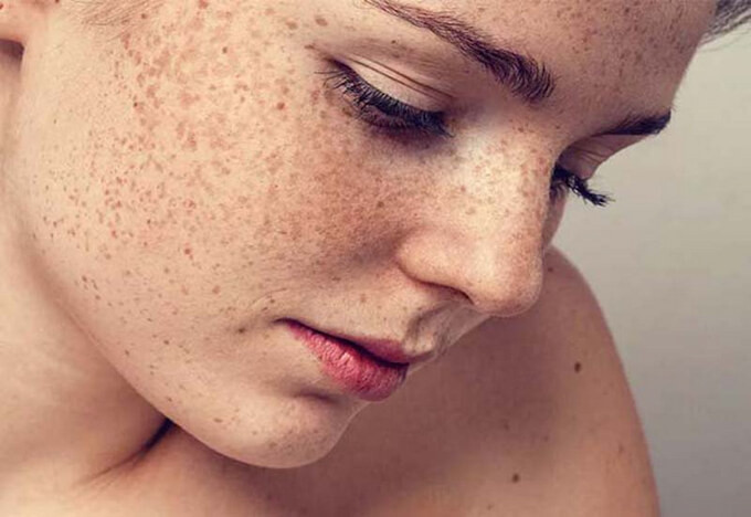 Những dấu hiệu trên khuôn mặt báo hiệu mỡ máu cao