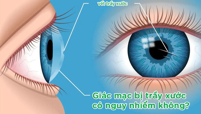 Giác mạc bị trầy xước có nguy hiểm không?