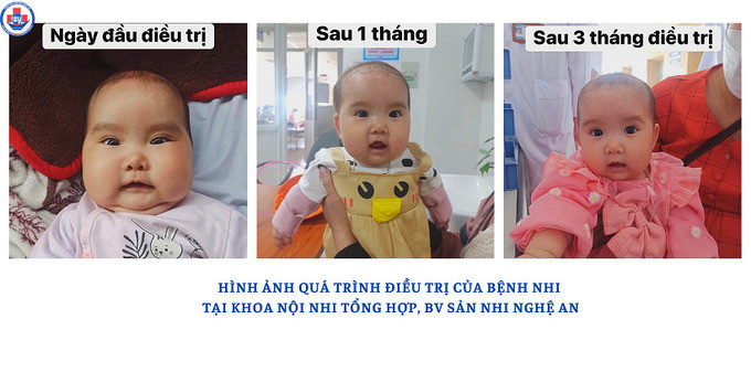 Nghệ An tiếp nhận nhiều bệnh nhi bị suy tuyến thượng thận do sử dụng corticoid