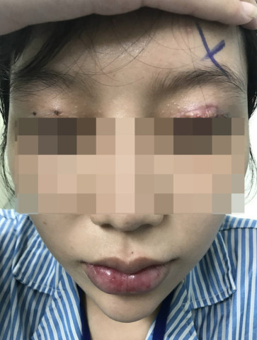 TP. HCM: Một nữ bệnh nhân 41 tuổi bị hỏng mắt do cắt mí tại thẩm mỹ viện "chui"