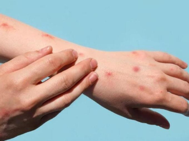Tăng cường nhập khẩu thuốc, để chủ động nghiên cứu, sản xuất thuốc điều trị bệnh đậu mùa khỉ