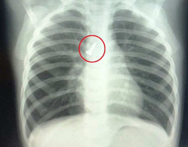 Hải Phòng cấp cứu thành công bé trai bị một chiếc đinh vít dài 1,5cm găm trong phế quản