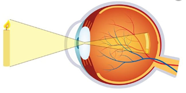 Các tật khúc xạ ở trẻ em