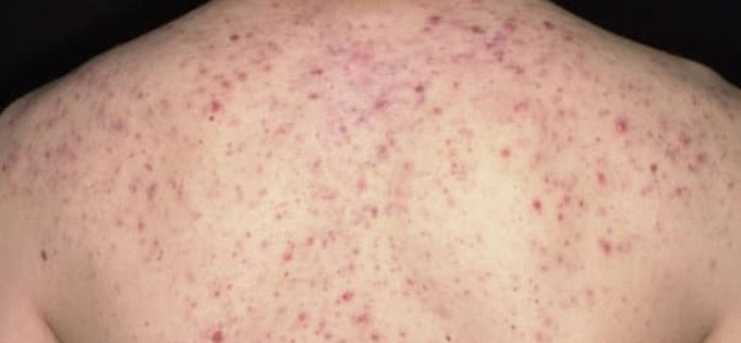 Hà Nội cấp cứu kịp thời bệnh nhân bị sốc phản vệ do trị mụn ở lưng tại spa