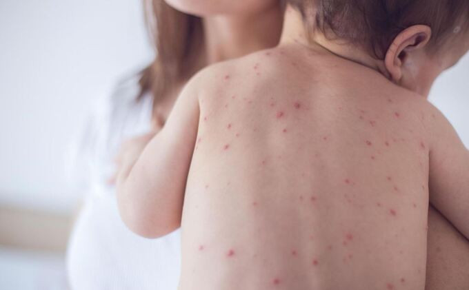 Hướng dẫn phòng ngừa lây nhiễm bệnh đậu mùa khỉ trong cơ sở khám, chữa bệnh
