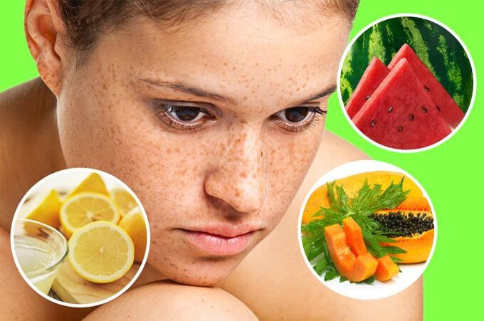 16 mẹo để loại bỏ vết thâm bằng các biện pháp tự nhiên