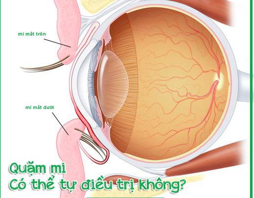 Quặm mi có thể tự điều trị không?