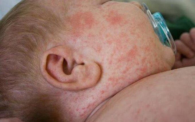 Những điều phụ huynh cần lưu ý khi chăm sóc trẻ bị sốt xuất huyết