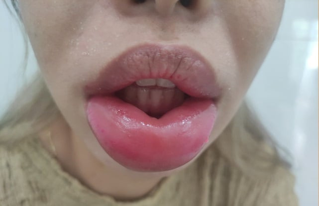 TP. HCM tiếp nhận và điều trị 2 bệnh nhân môi bị sưng phồng, đau nhức sau khi tiêm filler