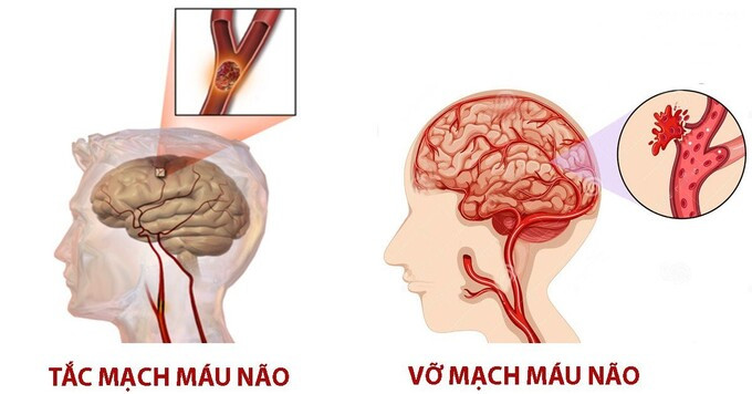 Nguyên nhân, dấu hiệu nhận biết và cách sơ cứu đột quỵ não
