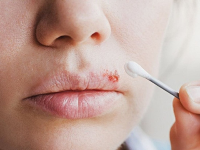 Cách điều trị mụn ở môi