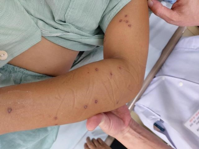 Quảng Ninh: Nữ bệnh nhân 24 tuổi bị sốc phản vệ sau khi ong vò vẽ đốt 70 nốt