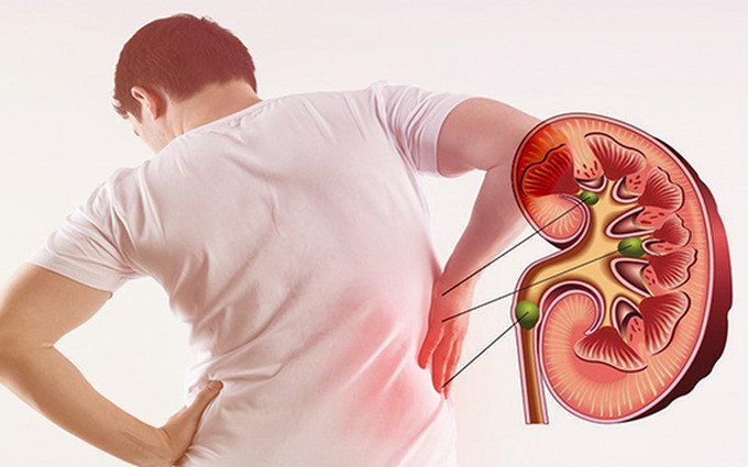 Bệnh nhân sỏi thận có nguy cơ bị loãng xương