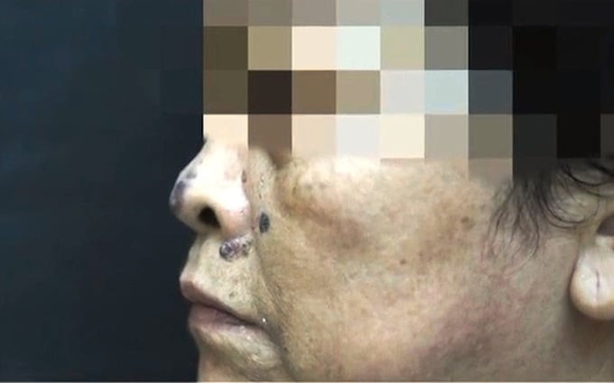 TP. HCM: Hơn 90% người trên 60 tuổi bị ung thư da trong gần 3.000 ca đến thăm khám mỗi năm