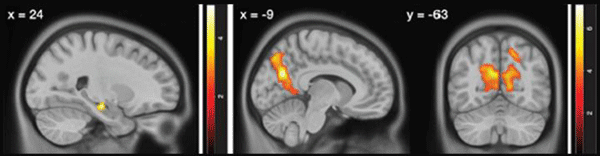 Hoạt động não quá mức có thể gây bệnh Alzheimer
