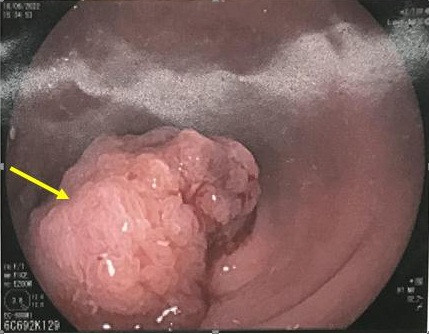 Các khuyến cáo đánh giá polyp đại trực tràng ác tính