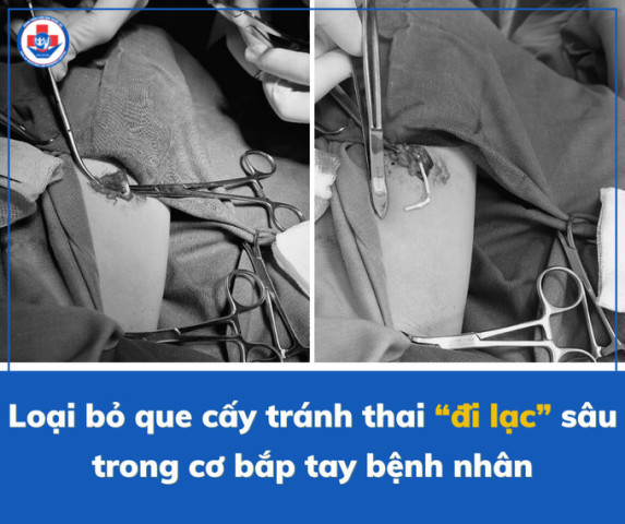Nghệ An phẫu thuật loại bỏ "que cấy tránh thai" "đi lạc" ra bắp tay nữ bệnh nhân 31 tuổi