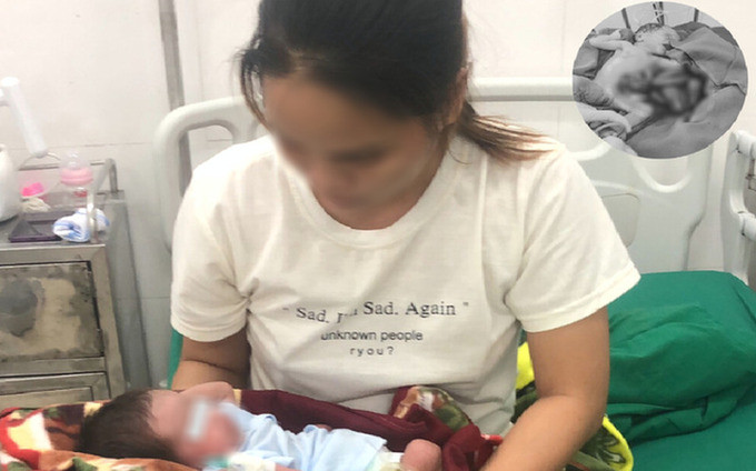 Nghệ An cấp cứu trẻ sơ sinh non có nội tạng nằm ngoài ổ bụng