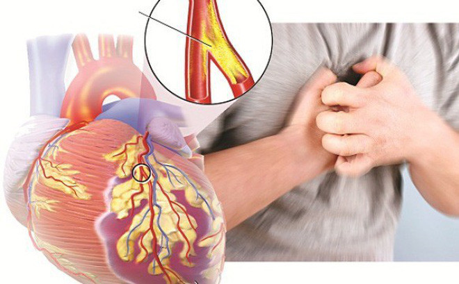 Điều trị bệnh động mạch vành bằng các bài thuốc đông y