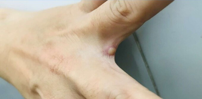 Tình trạng sức khỏe ca bệnh đậu mùa khỉ đầu tiên tại Việt Nam như thế nào?