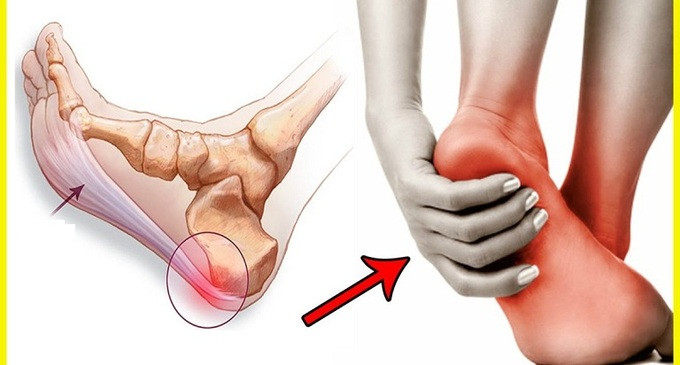 5 bài tập hỗ trợ điều trị viêm cân gan bàn chân