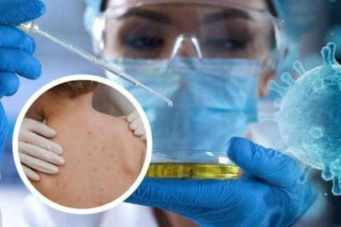 Thanh Hóa tăng cường phòng, chống bệnh đậu mùa khỉ
