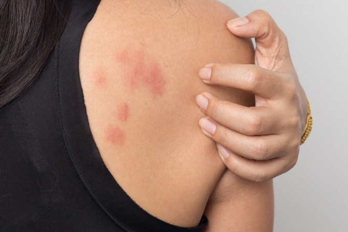 Lưu ý những dấu hiệu cảnh báo khi bạn bị dị ứng thức ăn