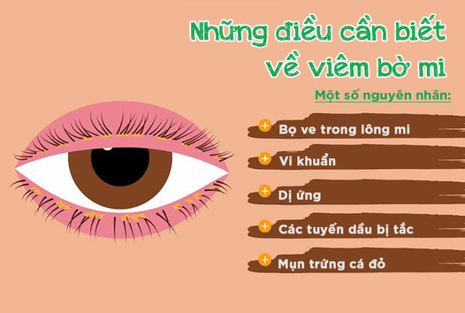 Những điều cần biết về viêm bờ mi