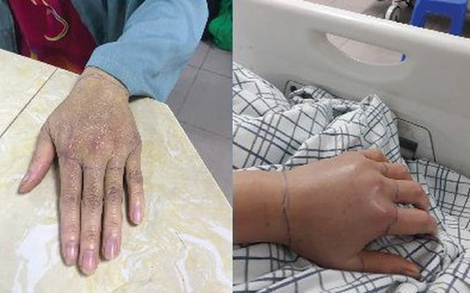Phú Thọ cứu sống kịp thời người bệnh bị rắn lục cắn