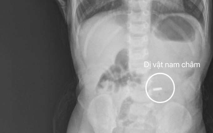 TP. HCM gắp dị vật nam châm ở đường tiêu hóa cho bé trai 18 tháng tuổi