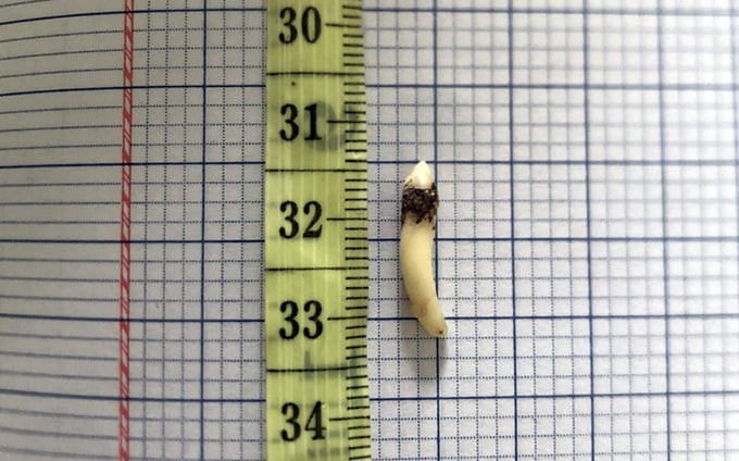 Đồng Nai gắp dị vật là chiếc răng thừa dài khoảng 2cm mọc ngược trong hốc mũi