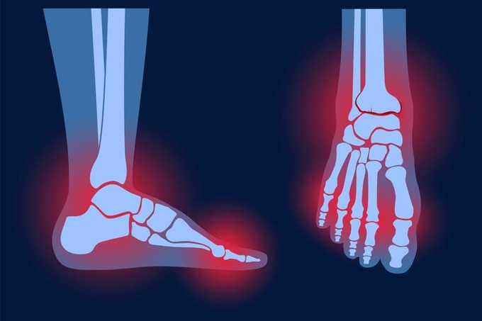 Bằng chứng mới liên kết vi khuẩn đường ruột với sự phát triển của bệnh viêm khớp dạng thấp