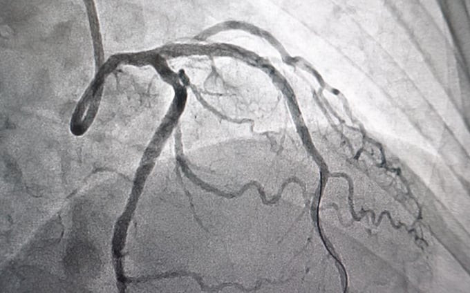 Đột phá trong việc đặt stent động mạch vành