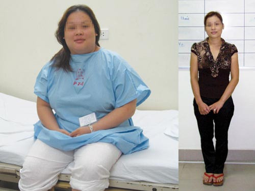 Các phương pháp phẫu thuật điều trị béo phì
