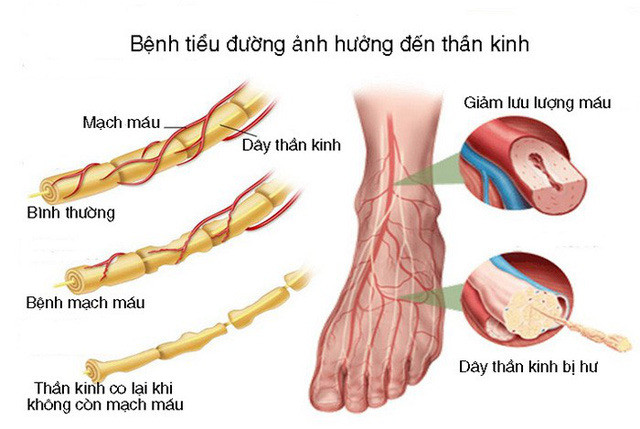 Vì sao bệnh tiểu đường lại gây hoại tử bàn chân?