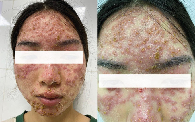 Hà Nội: Cô gái bị nhiễm Eczema herpesticum do đắp mặt "detox" tại spa