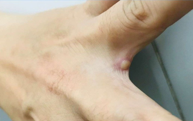 Đắk Lắk phát hiện một trường hợp trở về từ Nam Phi nghi mắc đậu mùa khỉ