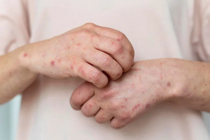 Sự lây truyền bệnh đậu mùa khỉ có thể xảy ra tới 4 ngày trước khi có triệu chứng