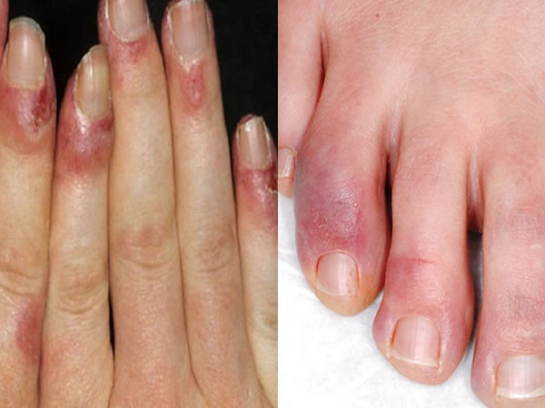 Một số bài thuốc ngâm chân trị cước chân hiệu quả